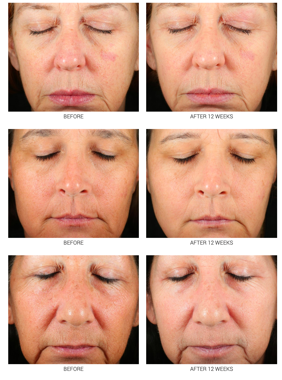 Advanced WRI-LAX 5x Retinoid Serum | Anti-Aging Treatment 2.5% & 5%