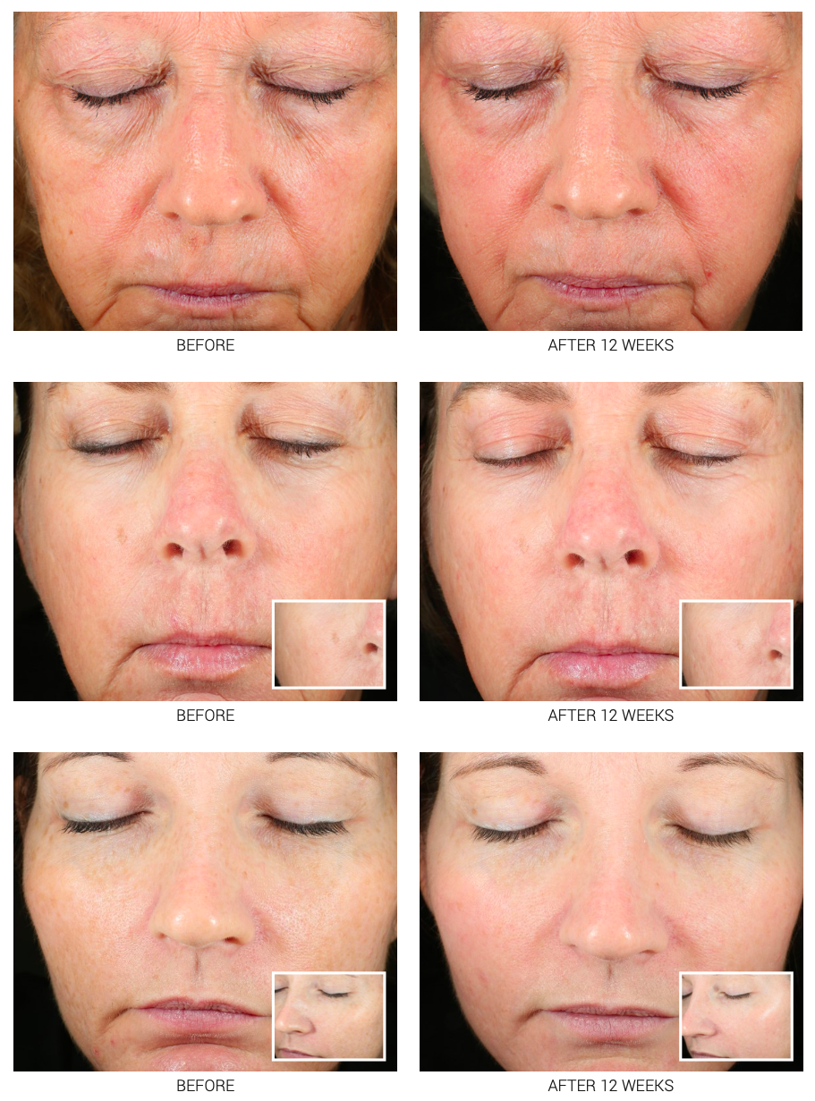 Advanced WRI-LAX 5x Retinoid Serum | Anti-Aging Treatment 2.5% & 5%
